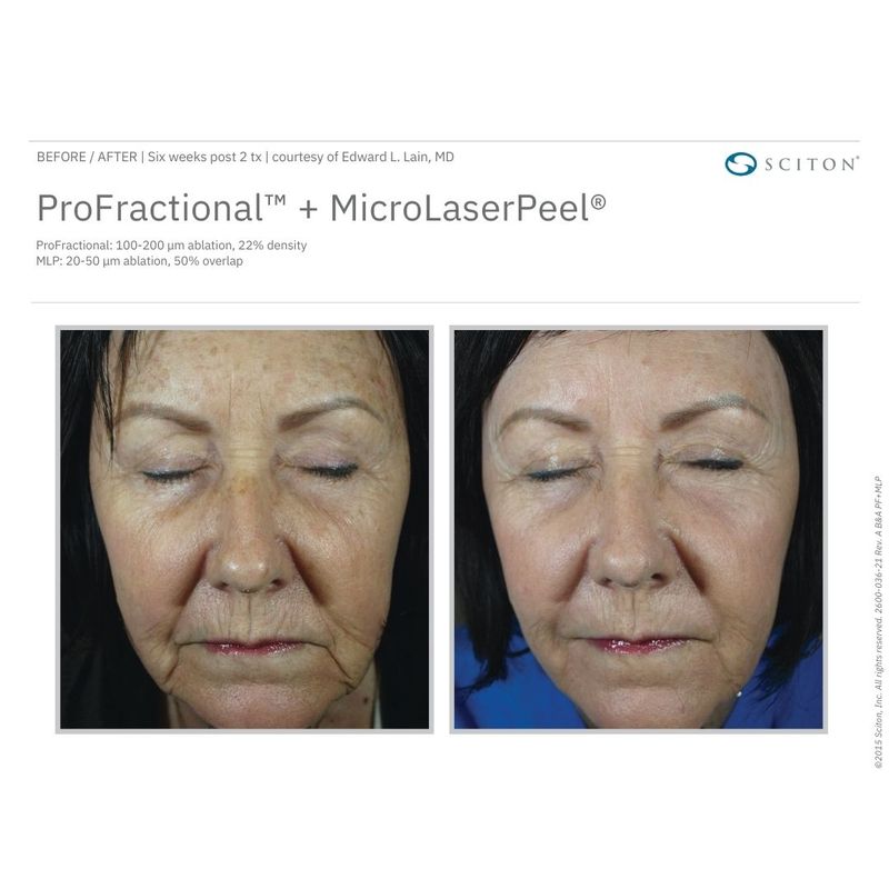 Sciton Microlaser Peel & Profractional | Restore by King Dermatology ...